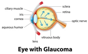 the Genetic Influence on Glaucoma Risk